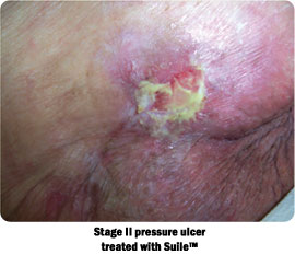 Stage II pressure ulcer