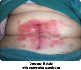 Duodenal fi stula with severe skin excoriation