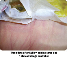 Three days after Suile™ administered and fi stula drainage controlled