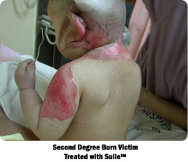 Second Degree Burn Victim Treated with Suile™